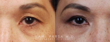 Asian eyelid surgery Before/After Photos | Kami Parsa MD Los Angeles, Beverly Hills