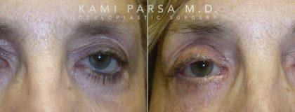 Revisional eyelid surgery Before/After Photos | Kami Parsa MD Los Angeles, Beverly Hills
