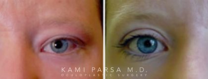 Revisional eyelid surgery Before/After Photos | Kami Parsa MD Los Angeles, Beverly Hills