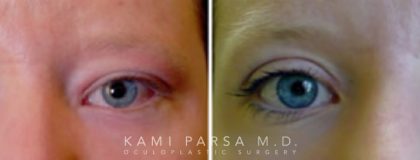 Gallery Before/After Photos | Kami Parsa MD Los Angeles, Beverly Hills