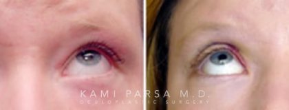 Gallery Before/After Photos | Kami Parsa MD Los Angeles, Beverly Hills