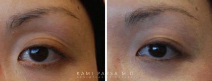 Asian eyelid surgery Before/After Photos | Kami Parsa MD Los Angeles, Beverly Hills