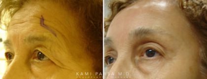 Brow Lift surgery Before/After Photos | Kami Parsa MD Los Angeles, Beverly Hills