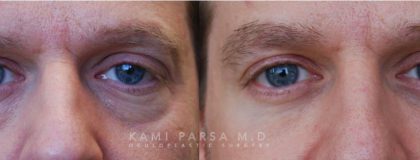 Lower eyelid surgery Before/After Photos | Kami Parsa MD Los Angeles, Beverly Hills