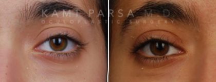 Ptosis surgery Before/After Photos | Kami Parsa MD Los Angeles, Beverly Hills