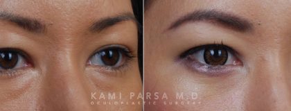 Asian eyelid surgery Before/After Photos | Kami Parsa MD Los Angeles, Beverly Hills