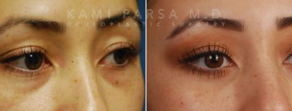 Gallery Before/After Photos | Kami Parsa MD Los Angeles, Beverly Hills