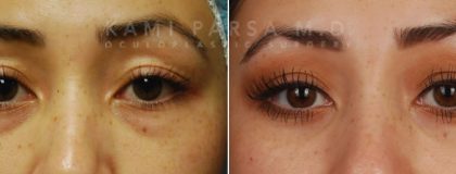 Asian eyelid surgery Before/After Photos | Kami Parsa MD Los Angeles, Beverly Hills
