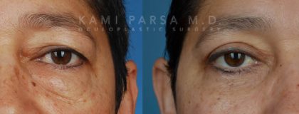 Upper eyelid surgery Before/After Photos | Kami Parsa MD Los Angeles, Beverly Hills