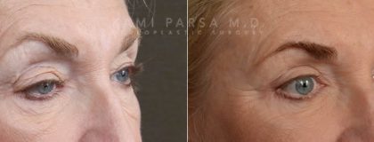 Ptosis surgery Before/After Photos | Kami Parsa MD Los Angeles, Beverly Hills
