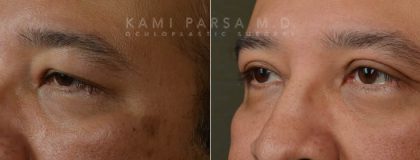 Upper eyelid surgery Before/After Photos | Kami Parsa MD Los Angeles, Beverly Hills