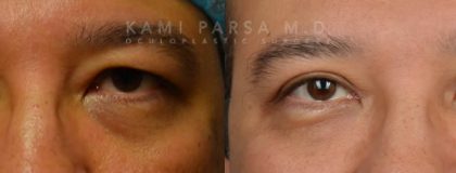Gallery Before/After Photos | Kami Parsa MD Los Angeles, Beverly Hills