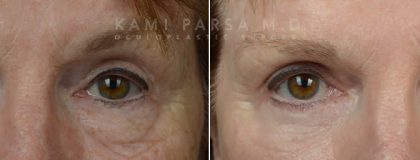 Upper eyelid surgery Before/After Photos | Kami Parsa MD Los Angeles, Beverly Hills