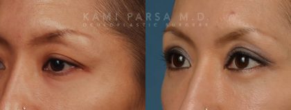 Asian eyelid surgery Before/After Photos | Kami Parsa MD Los Angeles, Beverly Hills