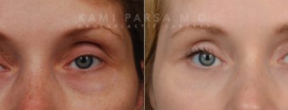 Revisional eyelid surgery Before/After Photos | Kami Parsa MD Los Angeles, Beverly Hills