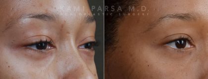 Gallery Before/After Photos | Kami Parsa MD Los Angeles, Beverly Hills