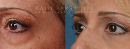 Fat injection Before/After Photos | Kami Parsa MD Los Angeles, Beverly Hills
