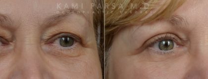 Upper eyelid surgery Before/After Photos | Kami Parsa MD Los Angeles, Beverly Hills