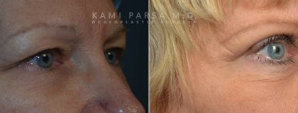 Brow Lift surgery Before/After Photos | Kami Parsa MD Los Angeles, Beverly Hills