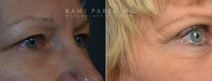 Upper eyelid surgery Before/After Photos | Kami Parsa MD Los Angeles, Beverly Hills