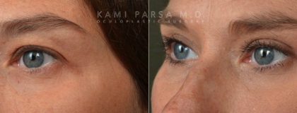 Upper eyelid surgery Before/After Photos | Kami Parsa MD Los Angeles, Beverly Hills