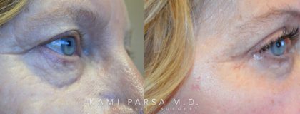 Fat injection Before/After Photos | Kami Parsa MD Los Angeles, Beverly Hills