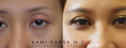 Gallery Before/After Photos | Kami Parsa MD Los Angeles, Beverly Hills