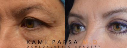 Upper eyelid surgery Before/After Photos | Kami Parsa MD Los Angeles, Beverly Hills