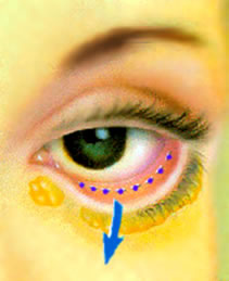 Image showing the incision behind the eyelid. Beverly Hills, CA