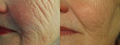 Gallery Before/After Photos | Kami Parsa MD Los Angeles, Beverly Hills