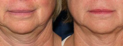 Gallery Before/After Photos | Kami Parsa MD Los Angeles, Beverly Hills