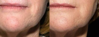 Gallery Before/After Photos | Kami Parsa MD Los Angeles, Beverly Hills