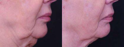 Gallery Before/After Photos | Kami Parsa MD Los Angeles, Beverly Hills