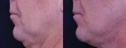 Gallery Before/After Photos | Kami Parsa MD Los Angeles, Beverly Hills