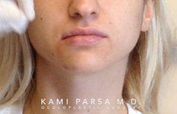 Lip Augmentation With Fillers