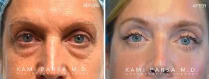Gallery Before/After Photos | Kami Parsa MD Los Angeles, Beverly Hills