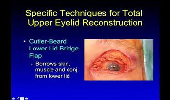 Total Eyelid Reconstruction