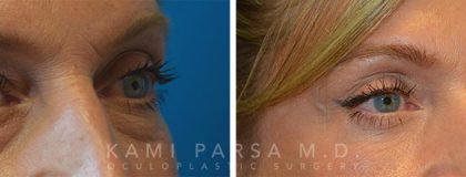 Fat injection Before/After Photos | Kami Parsa MD Los Angeles, Beverly Hills