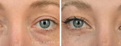 Gallery Before/After Photos | Kami Parsa MD Los Angeles, Beverly Hills