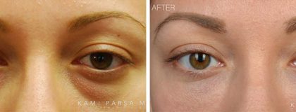 Facial Fillers and Botox Before/After Photos | Kami Parsa MD Los Angeles, Beverly Hills