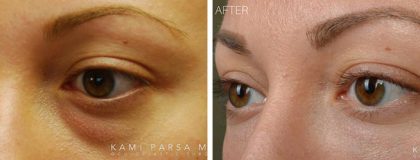 Facial Fillers and Botox Before/After Photos | Kami Parsa MD Los Angeles, Beverly Hills