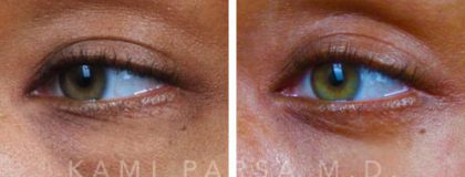 Lower eyelid surgery Before/After Photos | Kami Parsa MD Los Angeles, Beverly Hills