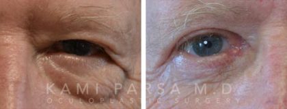 Upper eyelid surgery Before/After Photos | Kami Parsa MD Los Angeles, Beverly Hills