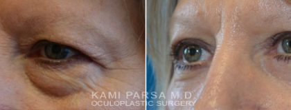 Upper eyelid surgery Before/After Photos | Kami Parsa MD Los Angeles, Beverly Hills