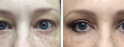 Upper eyelid surgery Before/After Photos | Kami Parsa MD Los Angeles, Beverly Hills