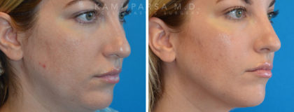 Facetite Before/After Photos | Kami Parsa MD Los Angeles, Beverly Hills