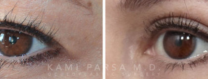 Upper eyelid surgery Before/After Photos | Kami Parsa MD Los Angeles, Beverly Hills