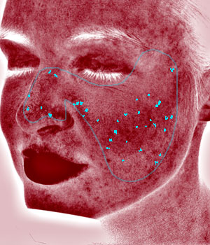 VISIA® Skin Analysis System test result showing red areas