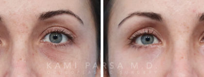 Trifecta Lift Before/After Photos | Kami Parsa MD Los Angeles, Beverly Hills