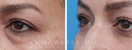 Trifecta Lift Before/After Photos | Kami Parsa MD Los Angeles, Beverly Hills